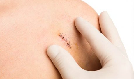 Professionnel pour le retrait de points de suture à domicile à Chavanay